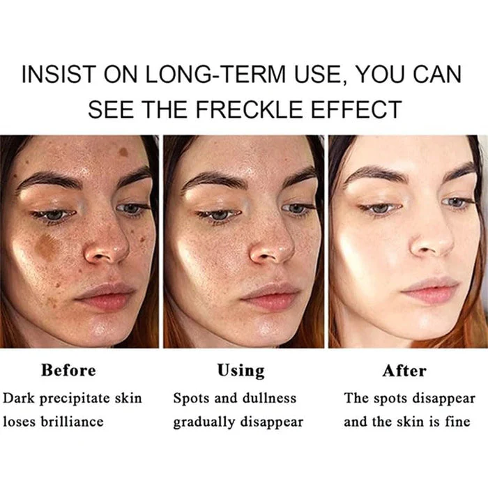 Acclyd Face Whitening Cream Dark Spot Remover for Face, Skin Lightening Cream, Hyperpigmentation Treatment Quick Effect, Freckles Melasma Brown Spot Corrector for Men Women (0.8 FL.OZ) - Image 4