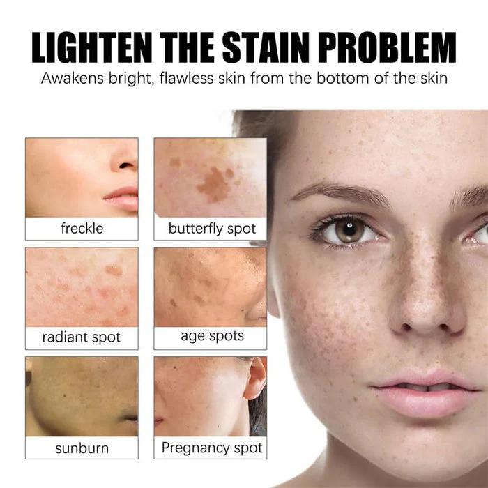 Acclyd Face Whitening Cream Dark Spot Remover for Face, Skin Lightening Cream, Hyperpigmentation Treatment Quick Effect, Freckles Melasma Brown Spot Corrector for Men Women (0.8 FL.OZ) - Image 7