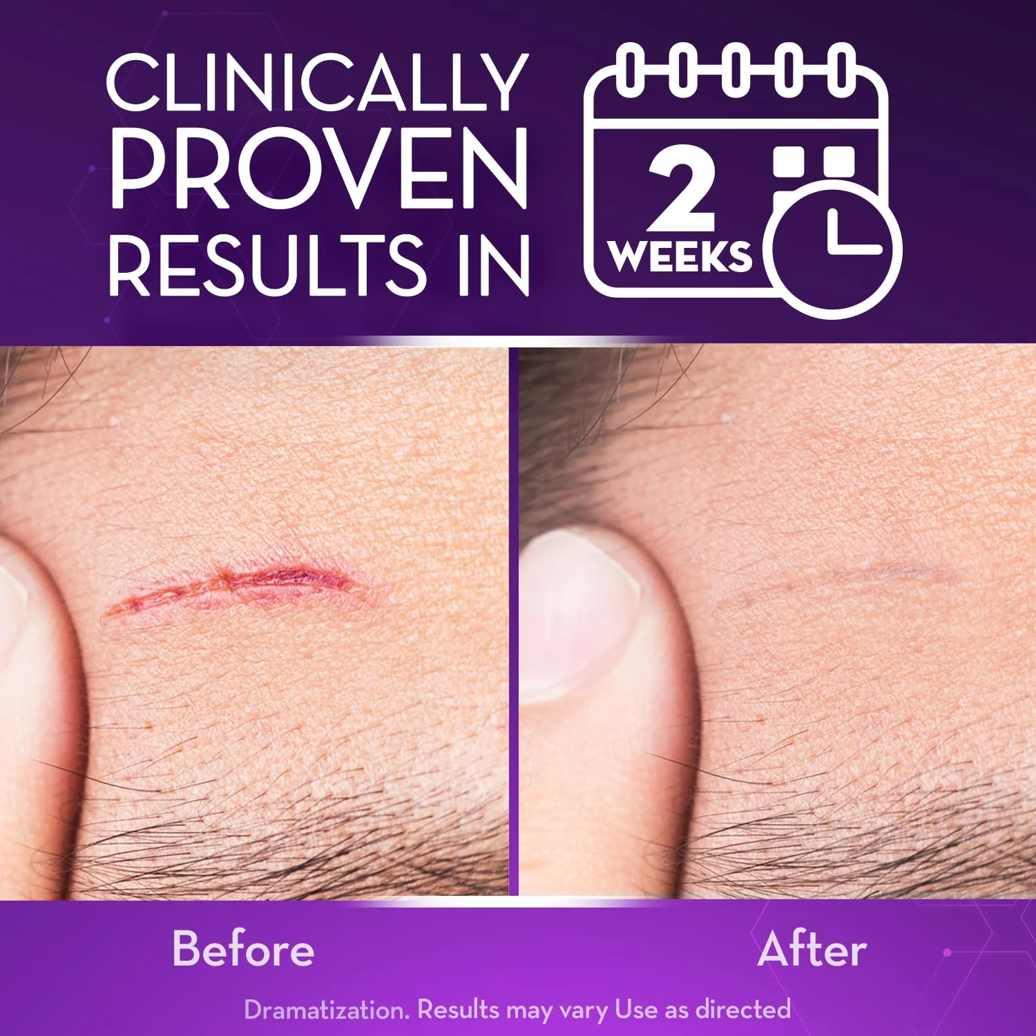 Cicatricure Advanced Scar Gel for Face & Body - Proven Results in 2 Weeks, Scar Treatment for Surgical Scars, Stretch Marks, Scars of Burns and Injuries, Acne Scar Treatment, 1 oz (28 g) - Pack of 2 - Image 7