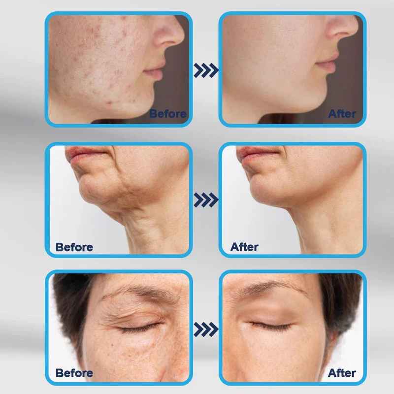 E DERMA STAMP 140 Adjustable 0-3mm - Image 6
