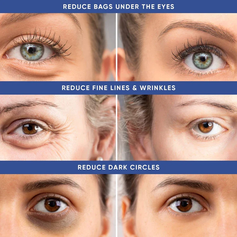 Instant Puffy Eye & Lift Treatment – Removes Under Eye Bags & Puffiness. Eliminate Dark Circles & Wrinkles. Naturally Ageless Hydrating Cream. Disappears Before Your Eyes Within Minutes. - Image 4