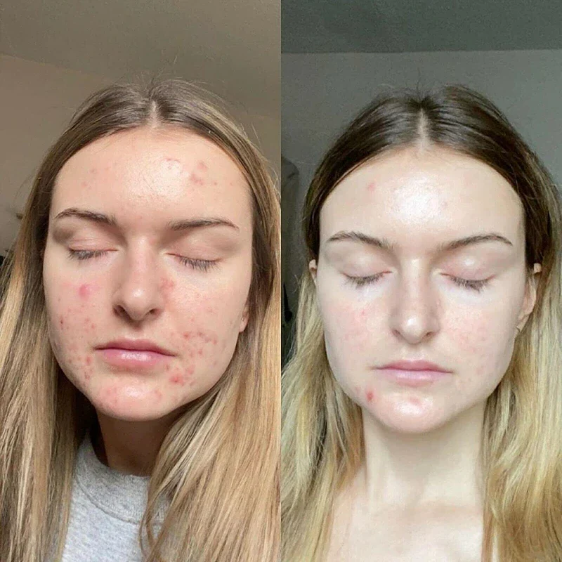 Retinol Gel 0.1 Vitamin A Repairs Fine Lines & Wrinkles, Scar Treatment, Age and Sun Spots, Anti-Aging Formula , 20 Grams - Image 4