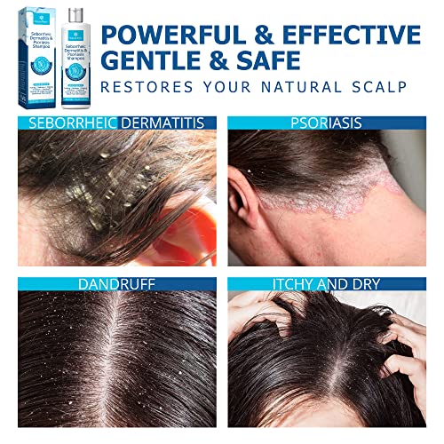 Roycederm Psoriasis Shampoo, Seborrheic Dermatitis Shampoo, Folliculitis Shampoo, Dandruff Shampoo, Scalp Psoriasis & Seborrheic Dermatitis Treatment, Dry Itchy Scalp Treatment - Image 6