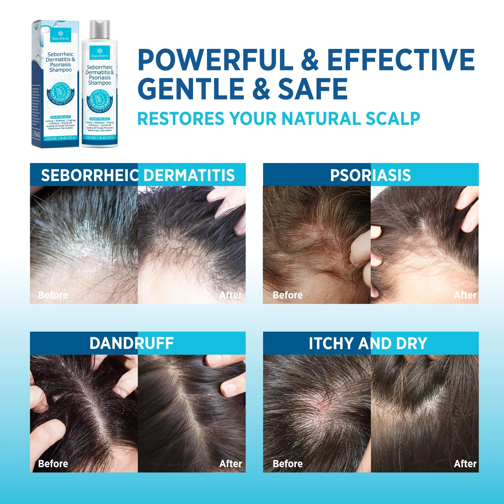 Roycederm Seborrheic Dermatitis & Psoriasis Shampoo and Conditioner Set - Effective Scalp Treatment for Folliculitis, Psoriasis, Dandruff, Dry Itchy Scalp - Soothing, Moisturizing Herbal Formula - Image 5