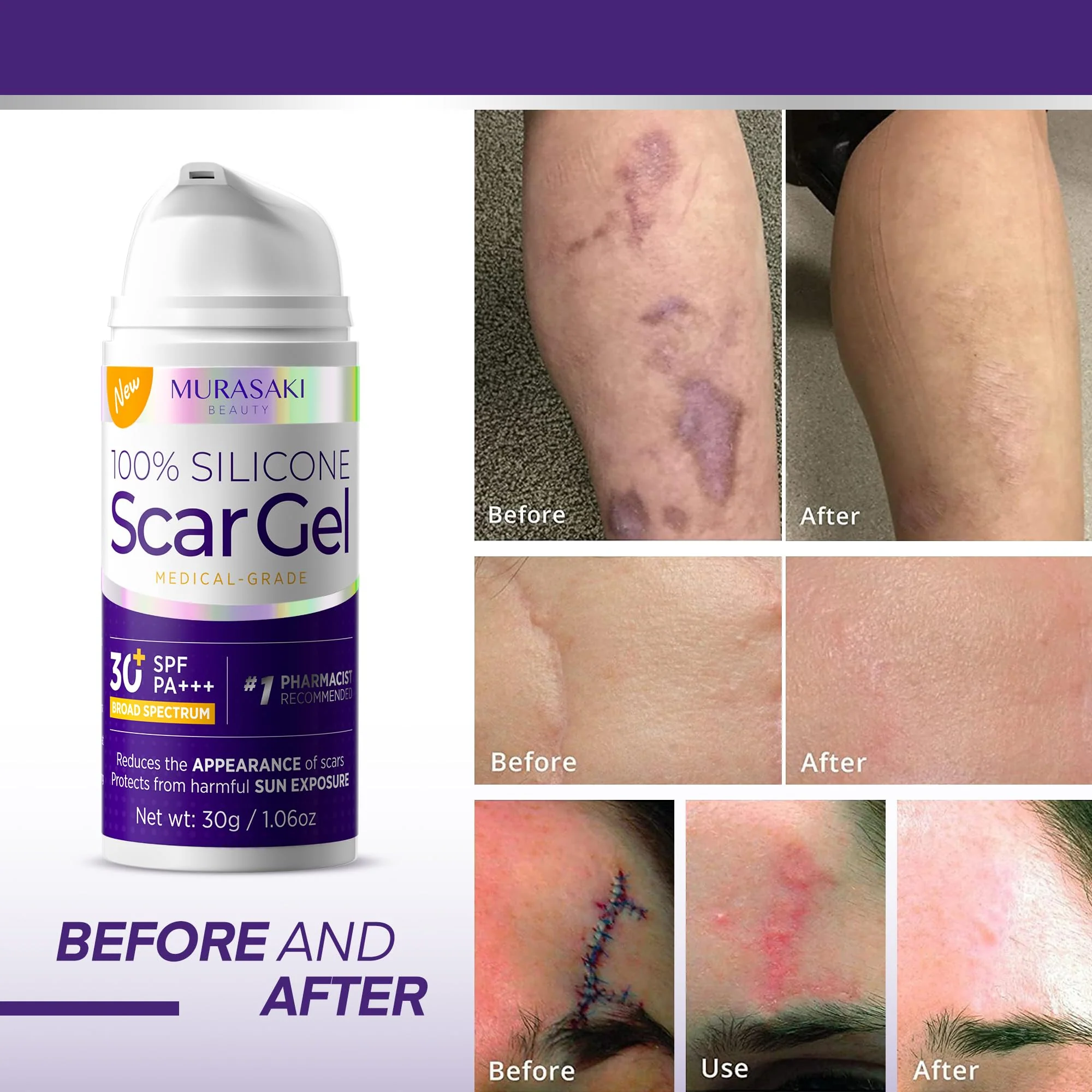 Silicone Scar Gel Scar Cream: SPF 30 Advanced Medical-Grade Formula for Surgical Scars, C-Section, Stretch Marks, Acne, Burns, Keloids, Old & New Scars – Broad Spectrum UV Protection 1.06oz (30g) - Image 9